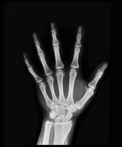 рентген руки человека